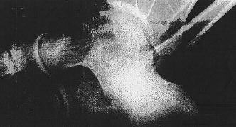 Xray